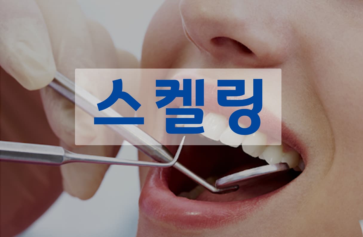 스켈링 투표 이미지